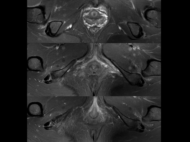Figure 3 for case ischiofemoral impingement